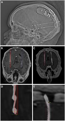 Accuracy and Workflow Improvements for Responsive Neurostimulation Hippocampal Depth Electrode Placement Using Robotic Stereotaxy